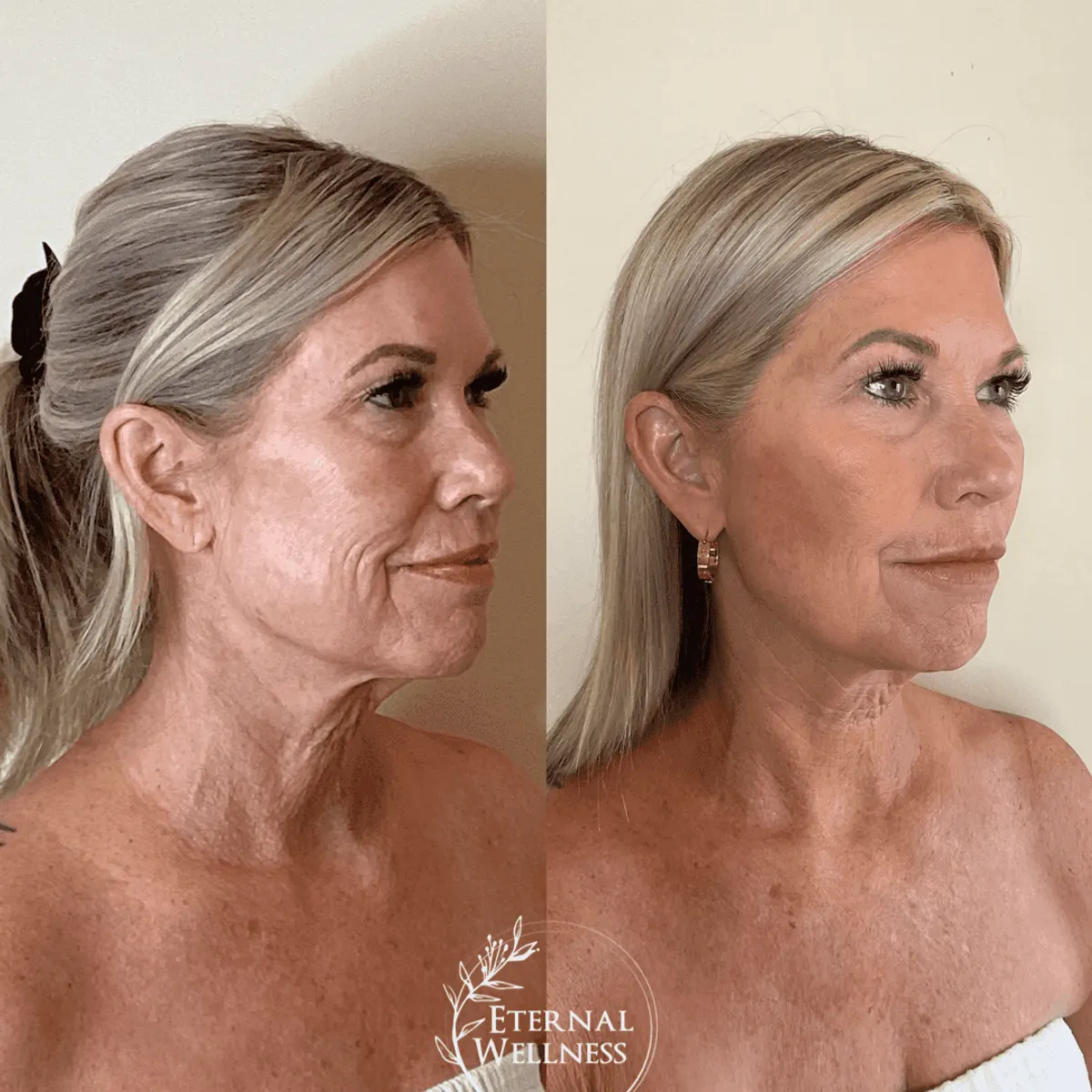 Morpheus8 RF Microneedling before and after