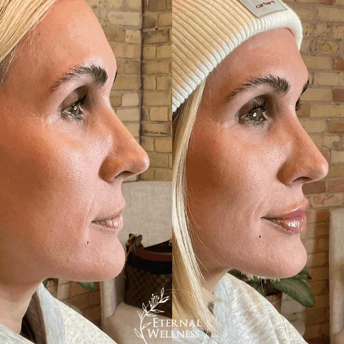 Restylane before and after