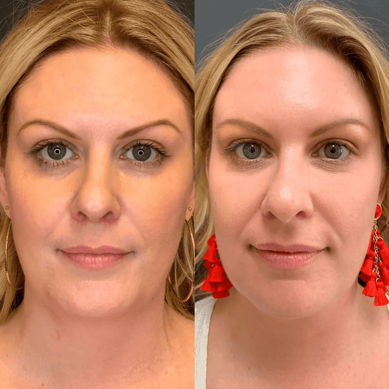 PRP & PRF - Before and After