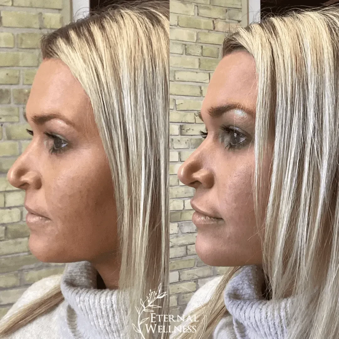Dermal Fillers - Before and After