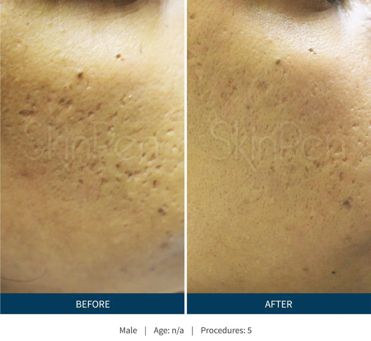 SkinPen before and after