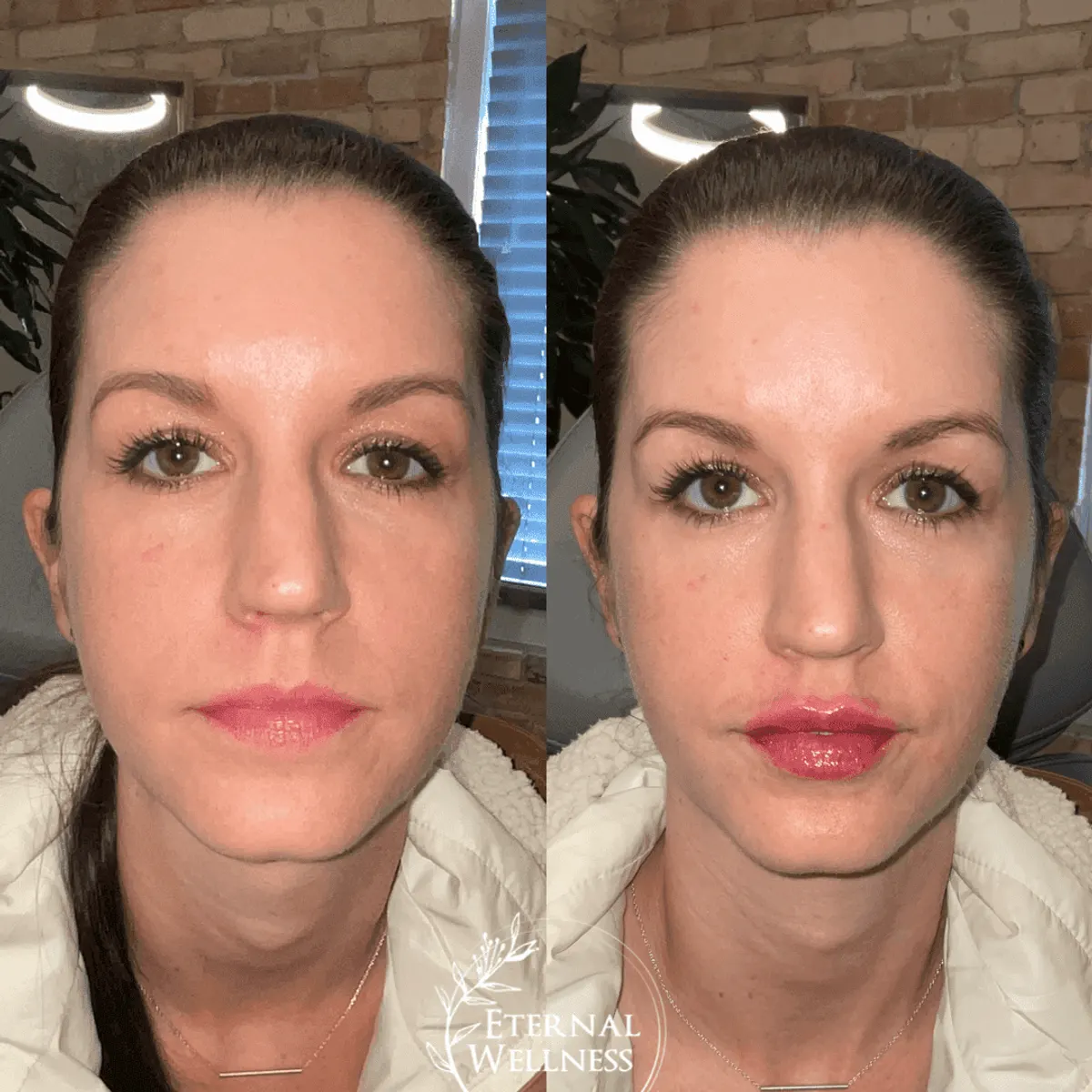 Restylane before and after