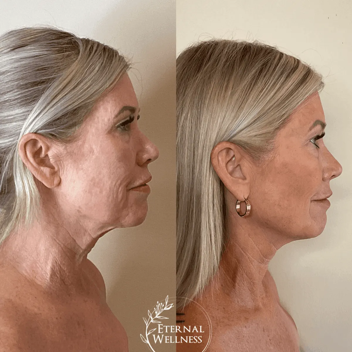 Morpheus8 Face before and after