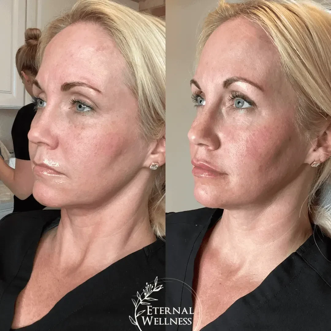 Dermal Fillers - Before and After