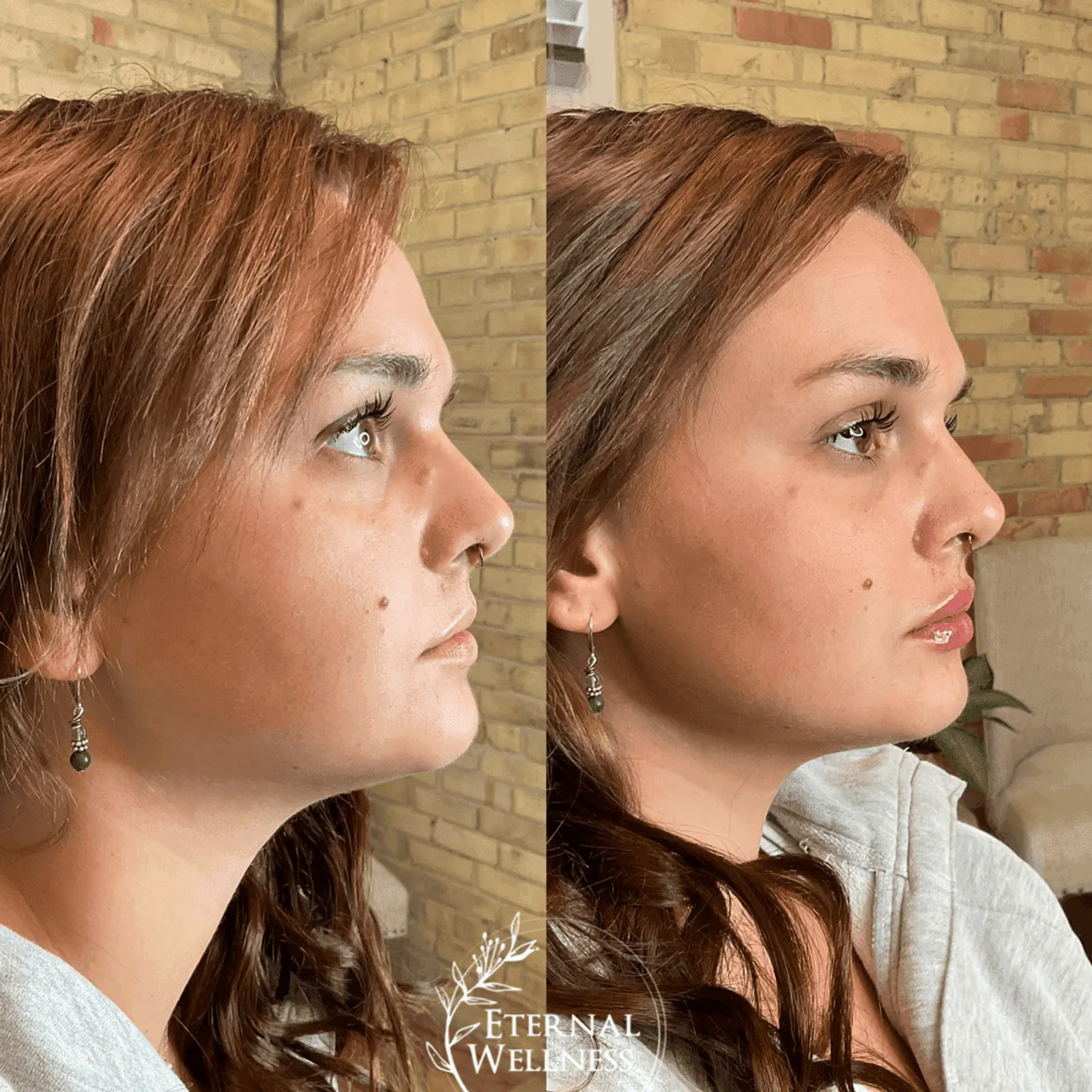 Restylane - Before and After