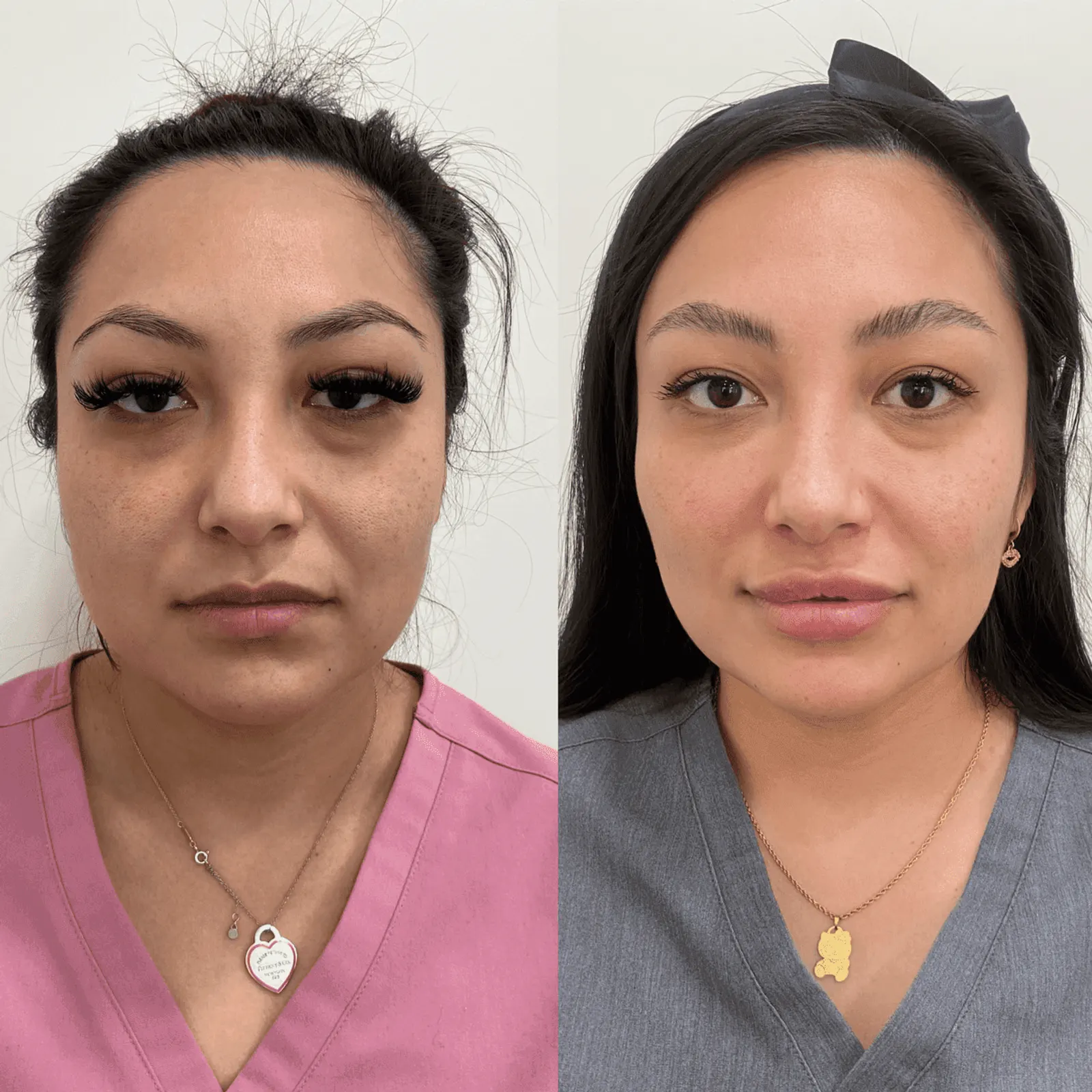 PRP & PRF - Before and After