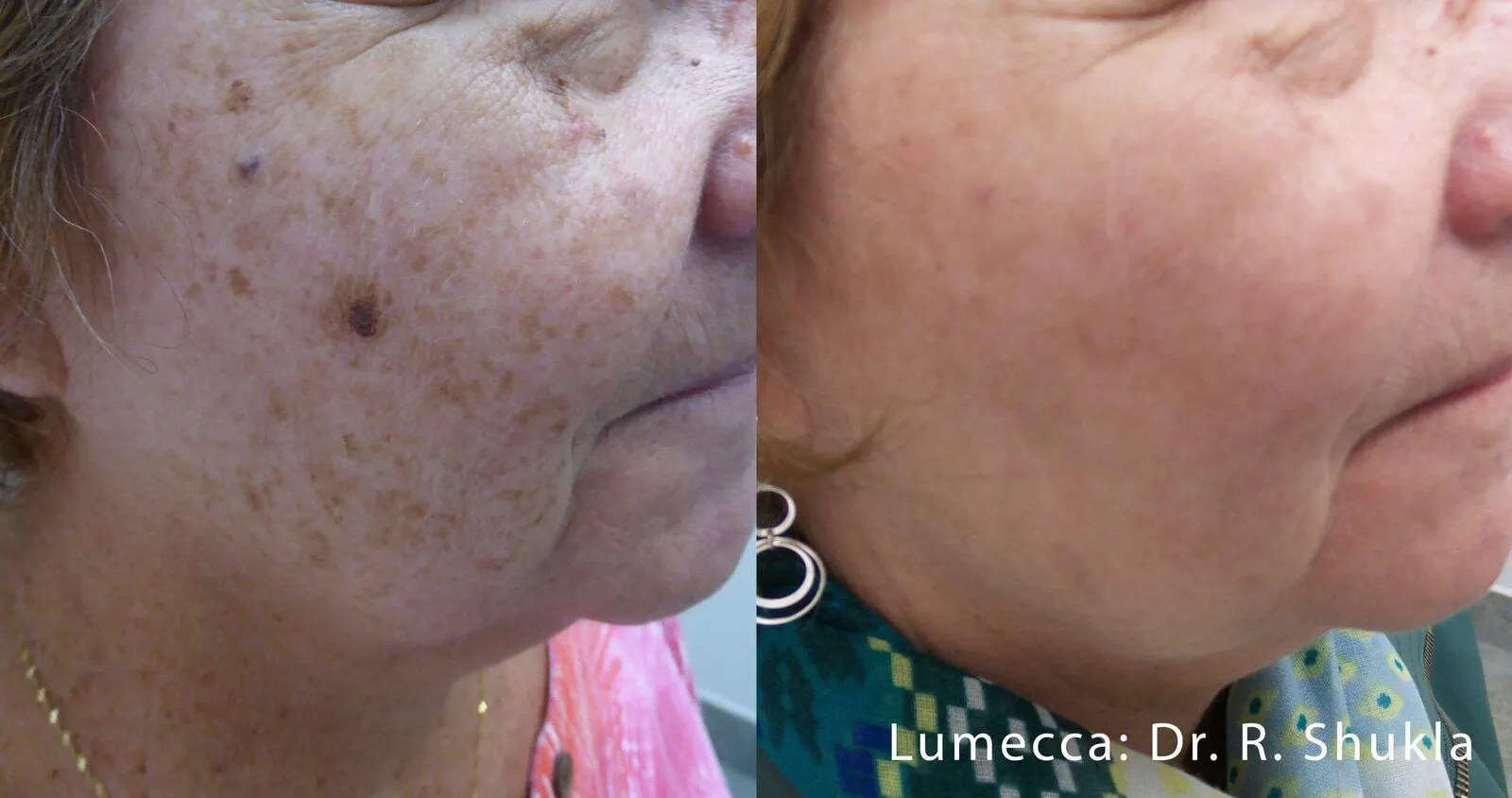 Lumecca IPL Face - Before and After