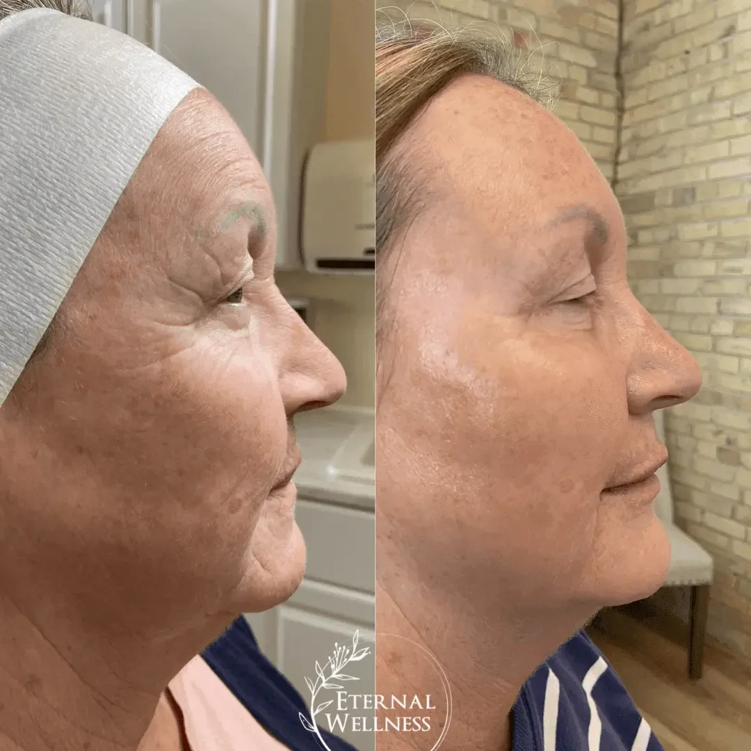 Dermal Fillers - Before and After