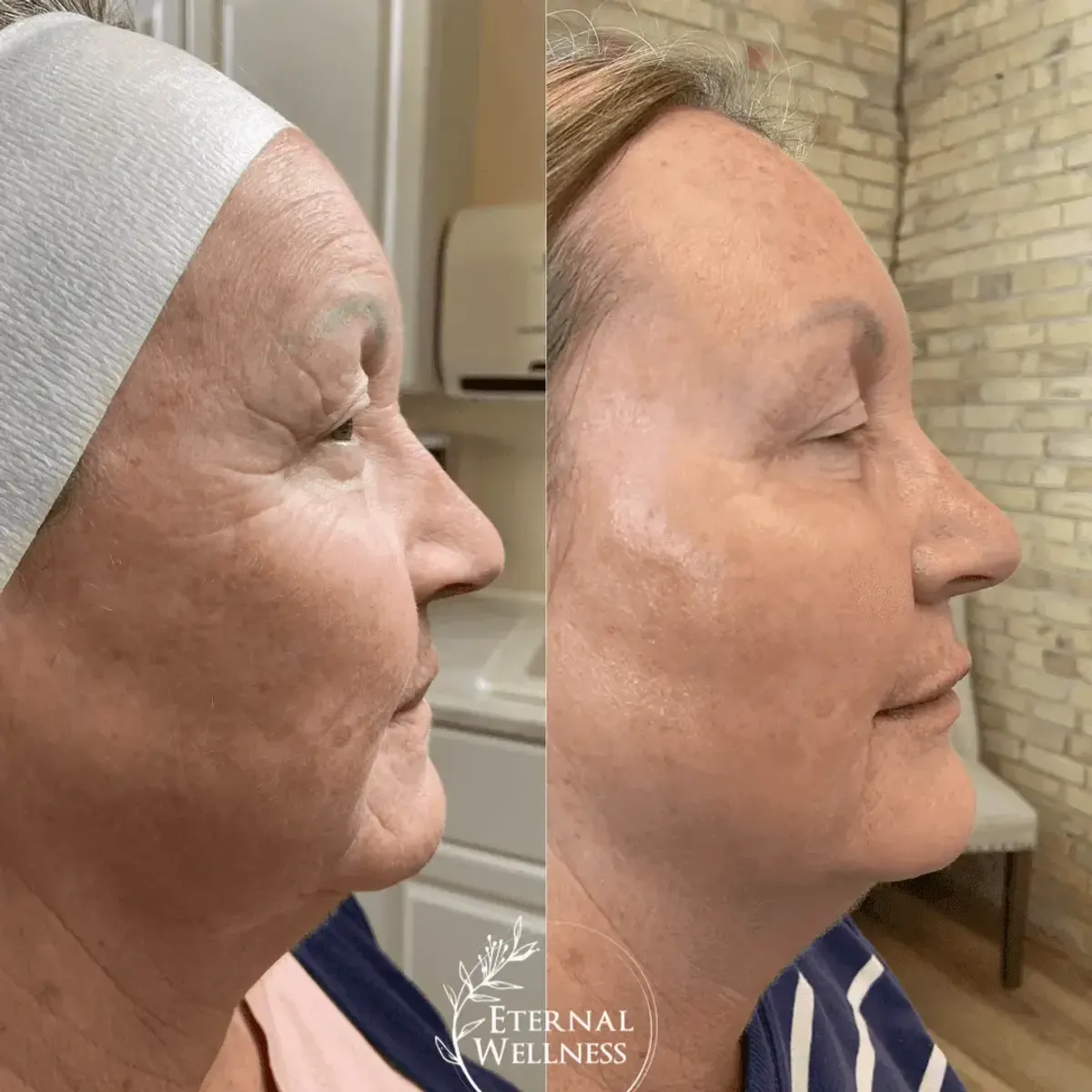 Dermal Fillers before and after