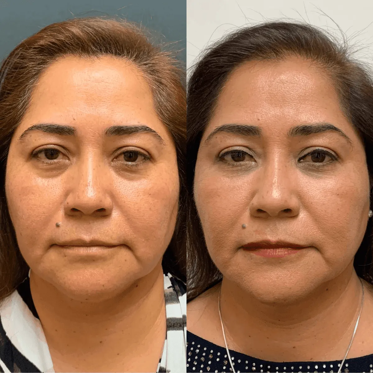 PRP & PRF before and after