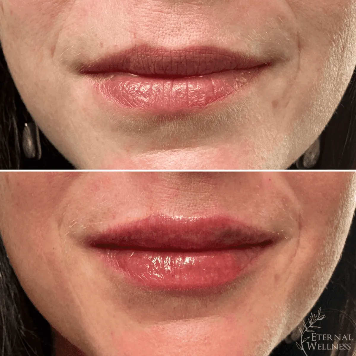 Restylane before and after