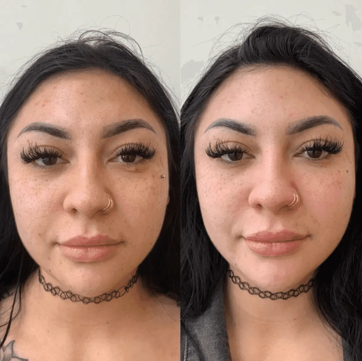 PRP & PRF before and after