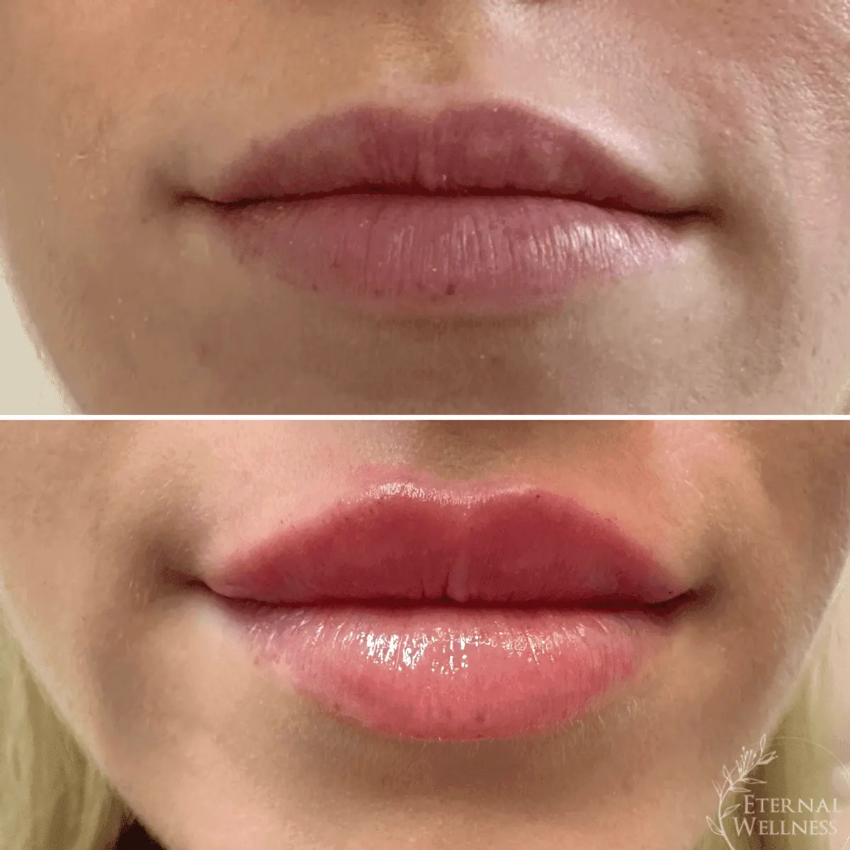 Restylane before and after