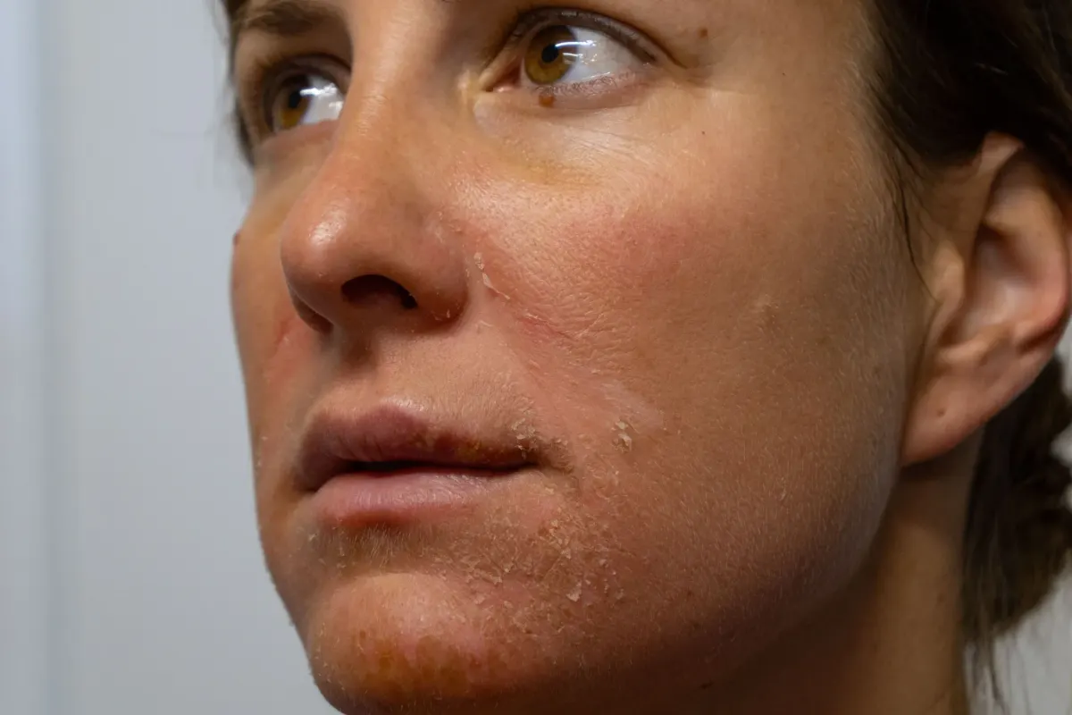 Close-up showing hyperpigmentation and uneven skin tone at Eternal Wellness Medical Spa Traverse City