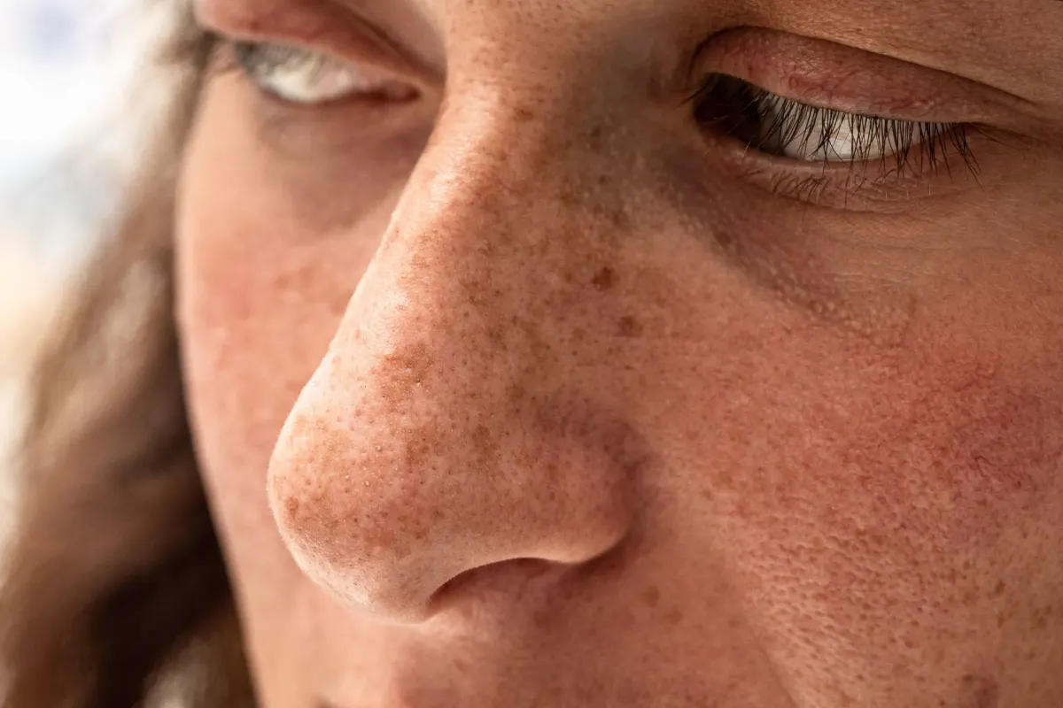 Woman with clear radiant skin after hyperpigmentation treatment at Eternal Wellness Medical Spa in Traverse City MI