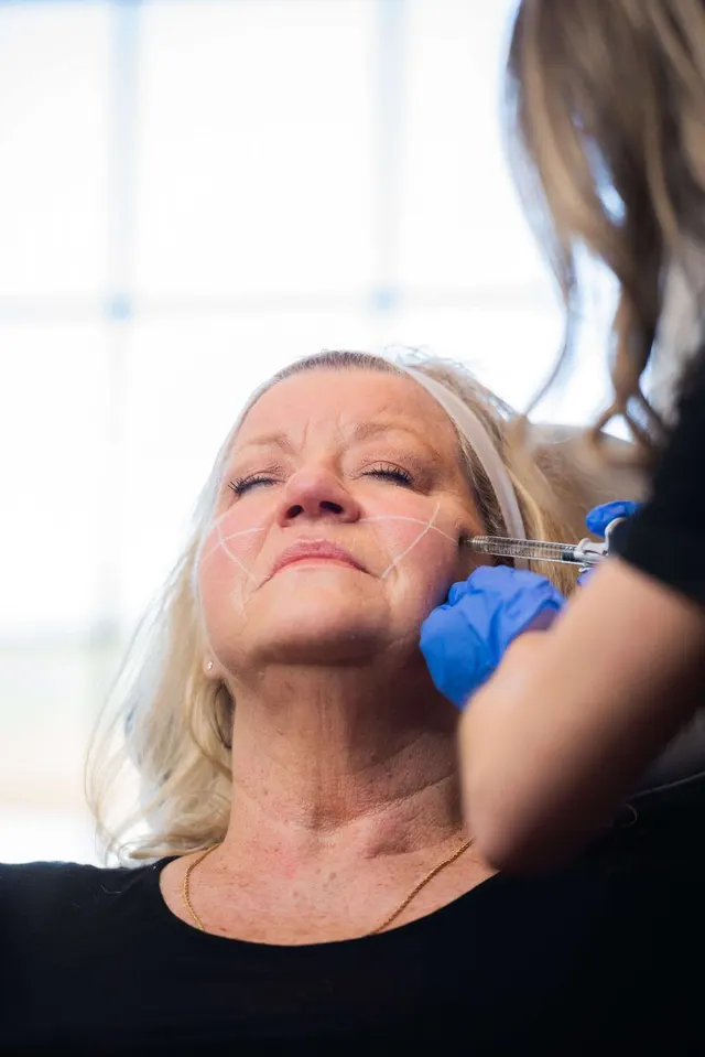 Before and after Restylane results showing volume restoration at Eternal Wellness Traverse City