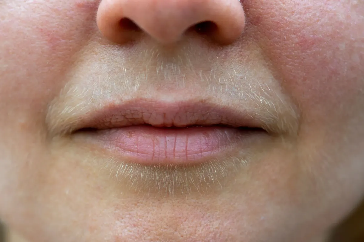 Understanding unwanted hair growth patterns at Eternal Wellness Medical Spa Traverse City
