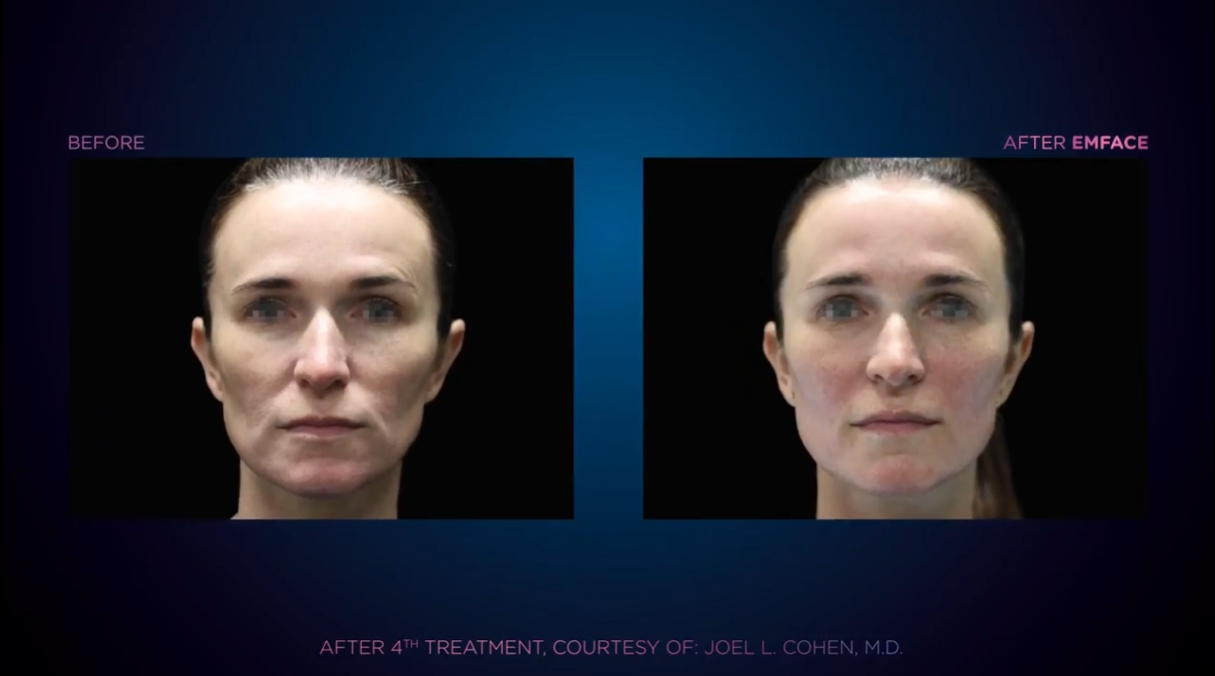 Emface before and after result 1