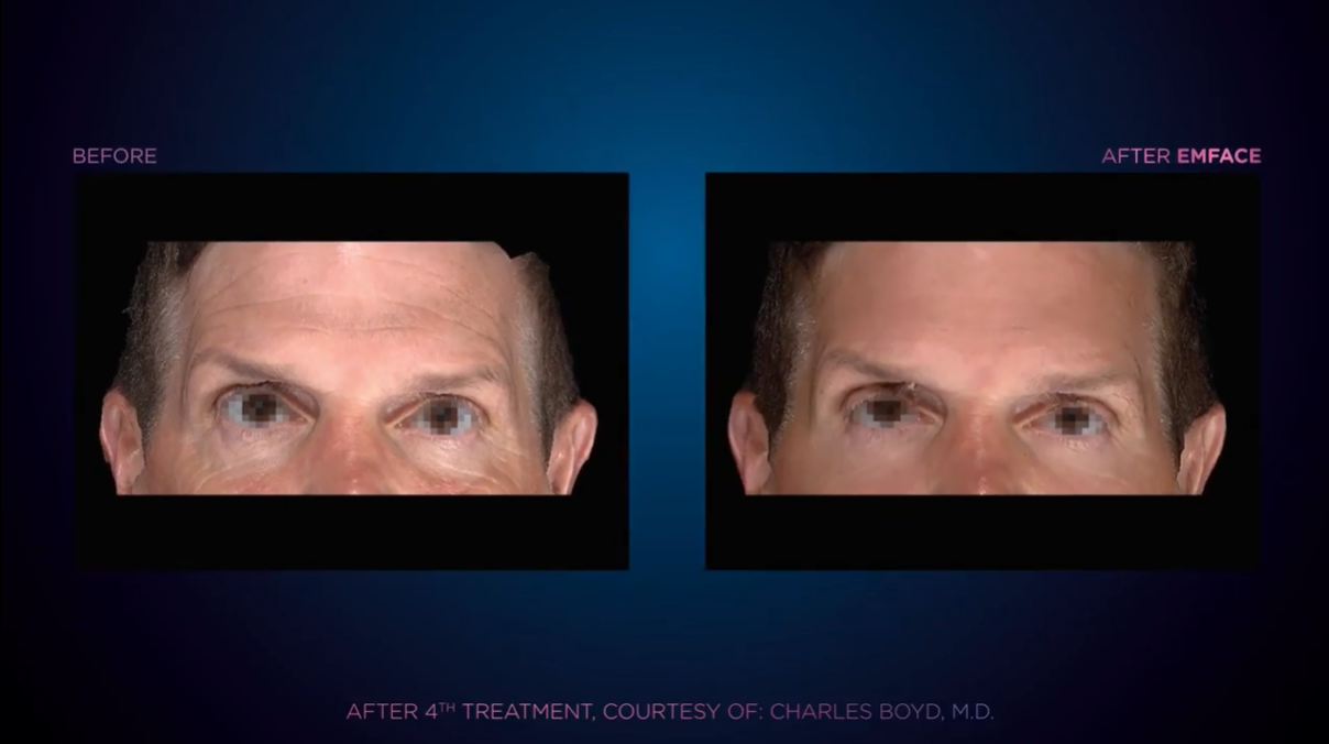 Emface before and after result 2