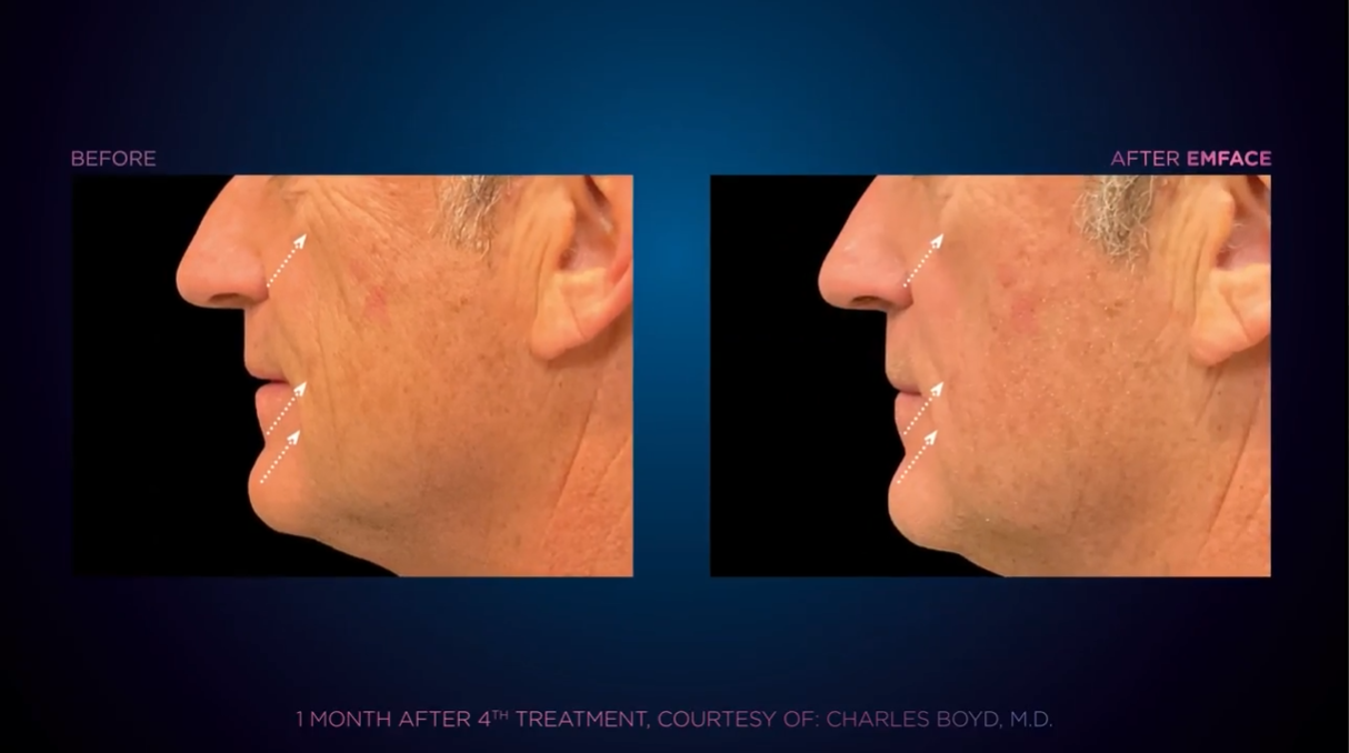 Emface before and after result 3